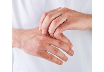 Psoriazis - beneficiile uleiului de canabis pentru tratament