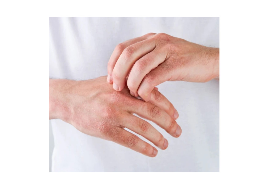 Psoriazis - beneficiile uleiului de canabis pentru tratament